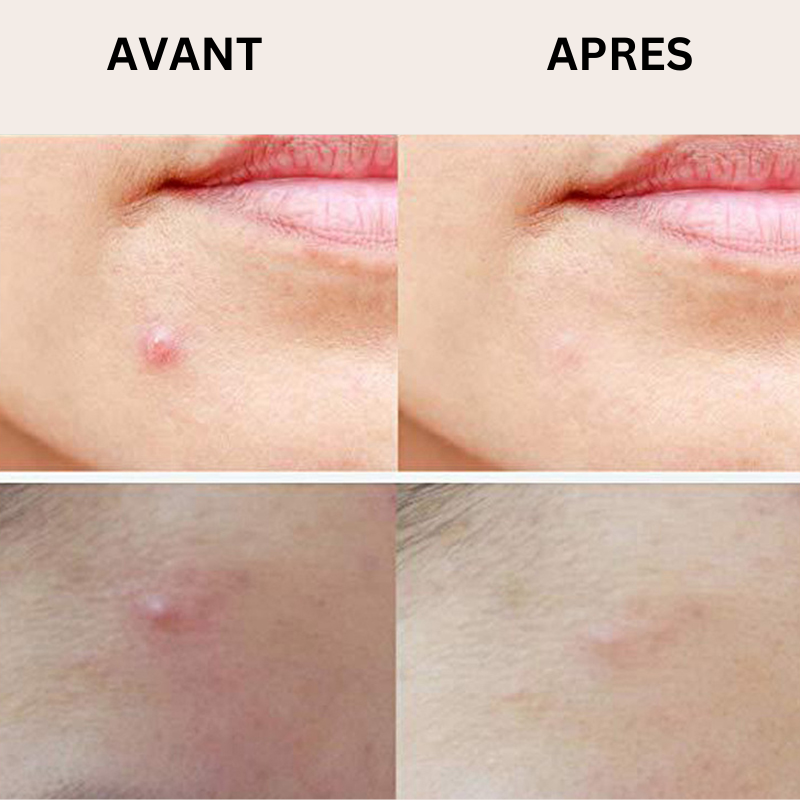 Patch micro-aiguilles Réduit les boutons douloureux en une nuit (sans les percer)
